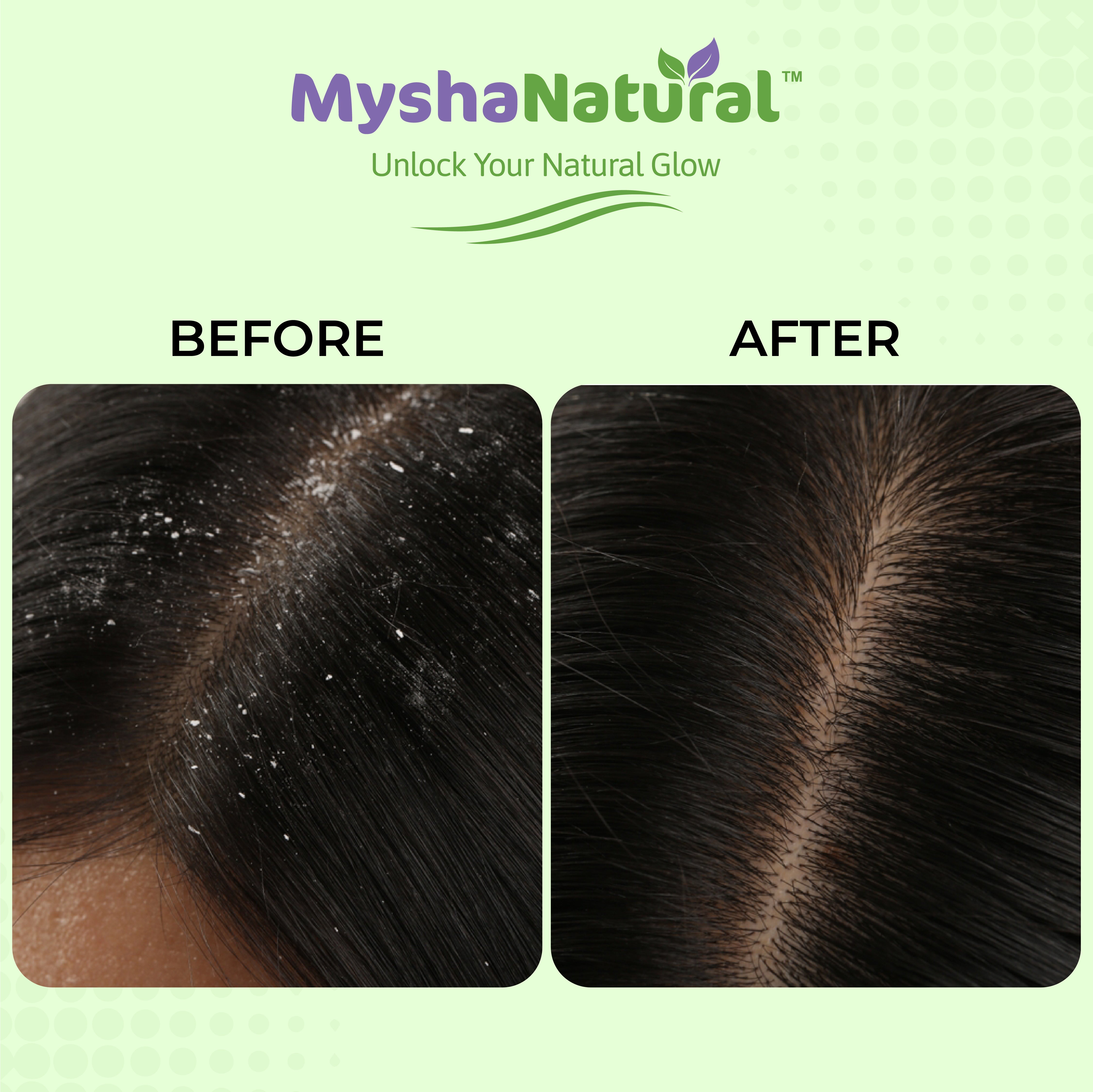 Mysha Natural Anti-Dandruff Hair Oil & Natural Shampoo Combo – Controls Dandruff, Reduces Hair Fall & Nourishes Scalp – 50ml + 200ml