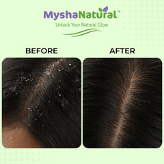 Mysha Natural Anti-Dandruff Hair Oil & Natural Shampoo Combo – Controls Dandruff, Reduces Hair Fall & Nourishes Scalp – 50ml + 200ml